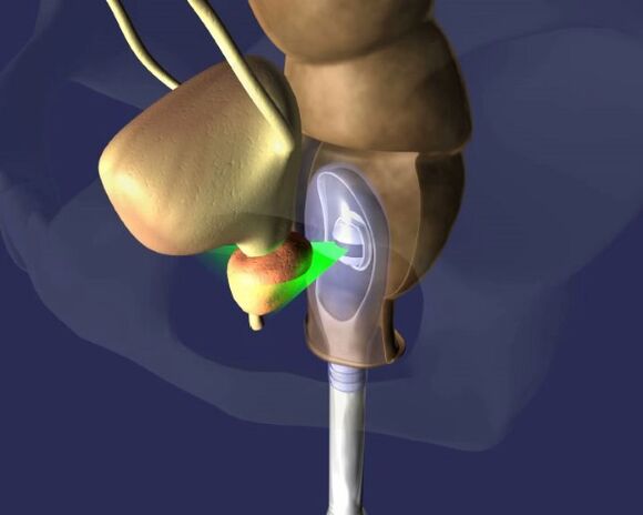 os efectos dos ultrasóns na próstata na prostatite