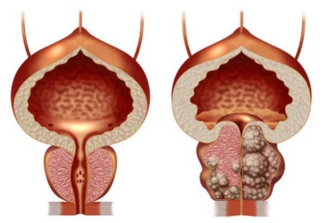 próstata saudable e adenoma de próstata