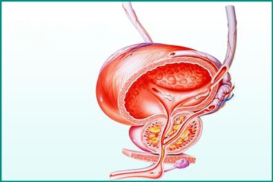 A inflamación da próstata na prostatite aguda representa unha restrición durante o sexo