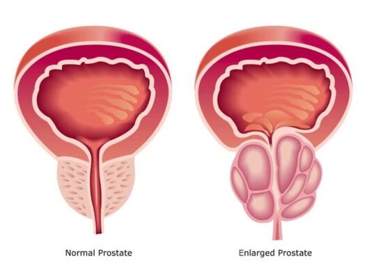 Próstata normal e agrandada