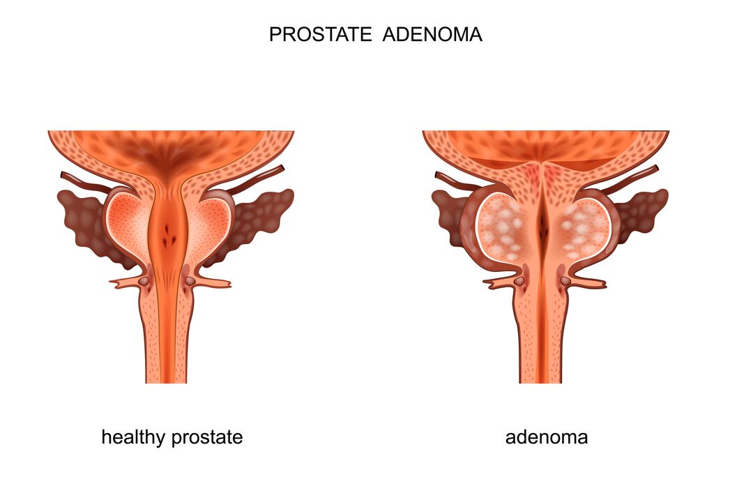 próstata sa e con adenomas